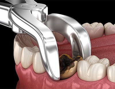 Illustration of damaged tooth being removed